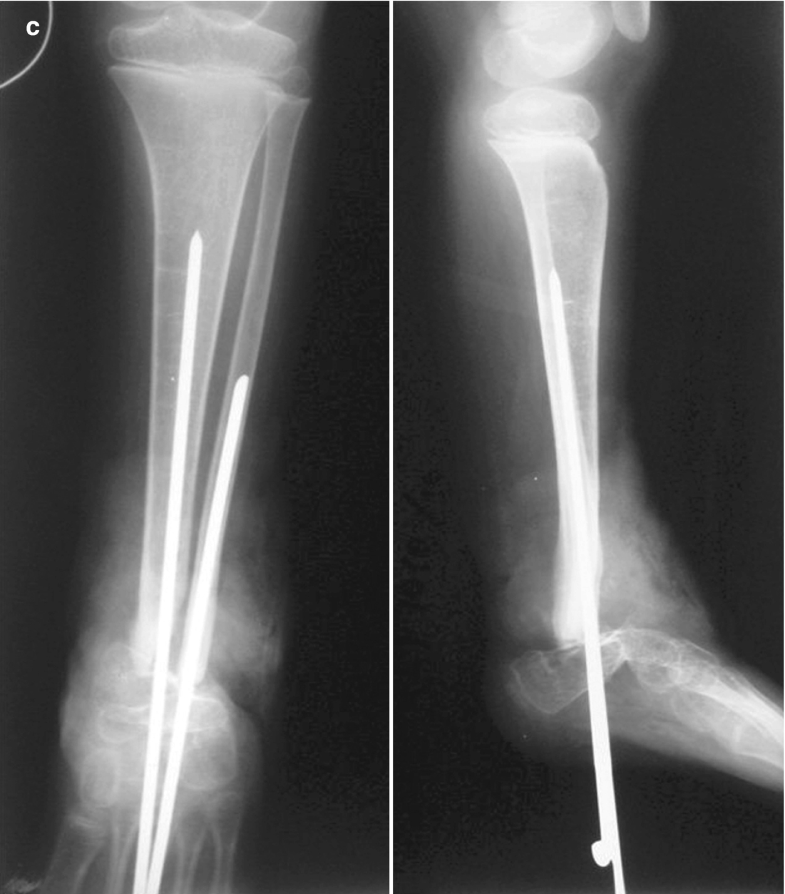 Neglected Septic Arthritis in Children SpringerLink