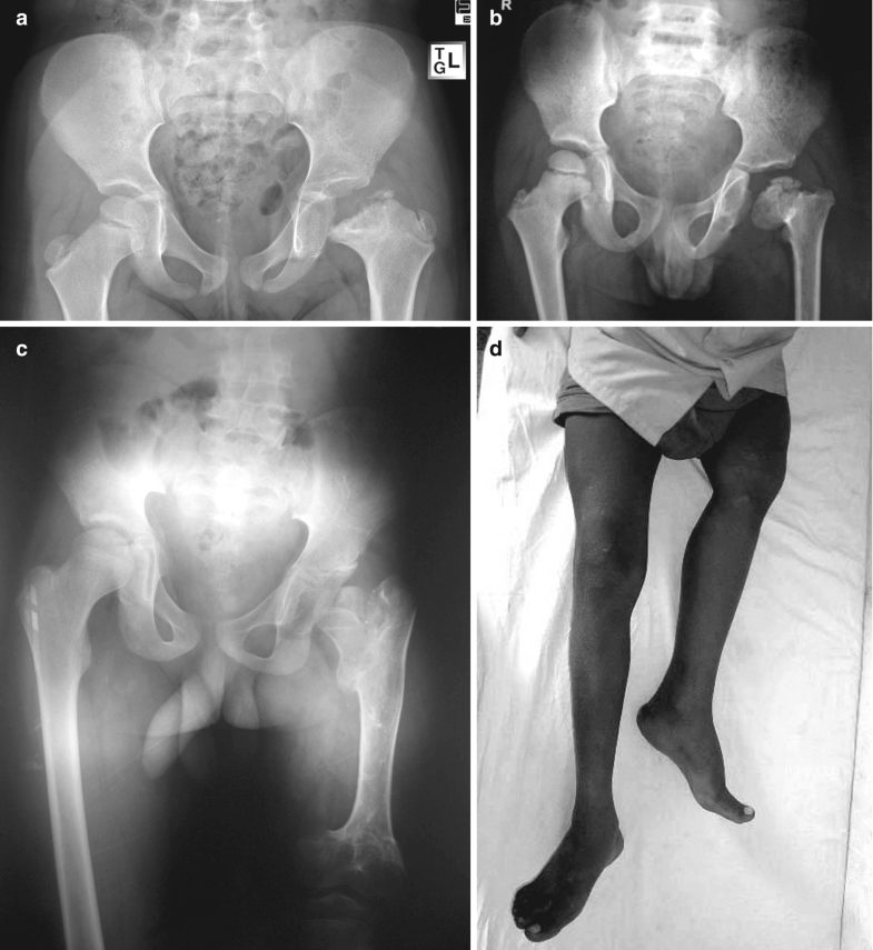 Neglected Septic Arthritis in Children SpringerLink