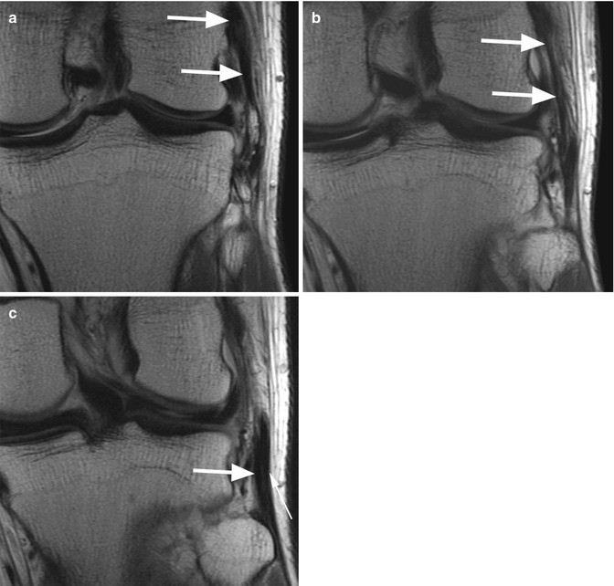 Lateral Collateral Ligament (LCL) and Posterolateral Corner (PLC