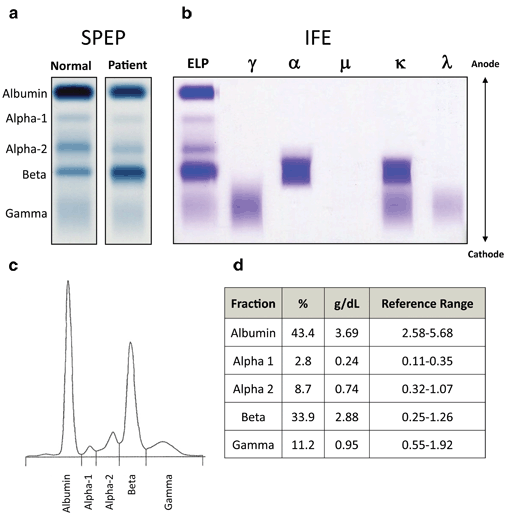 Clinical Protein and Immunofixation Electrophoresis SpringerLink