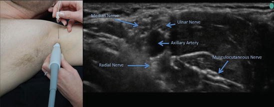 Regional Anesthesia for Elbow and Hand Surgery | SpringerLink
