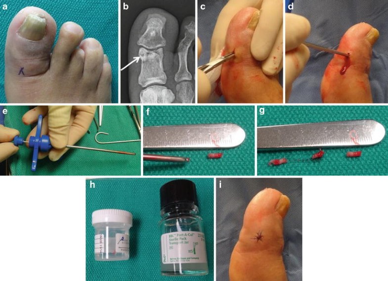 Bone Biopsy Techniques SpringerLink