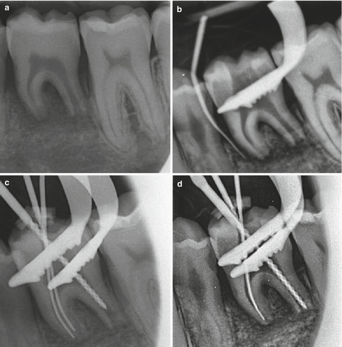 Root Canal Obturation SpringerLink