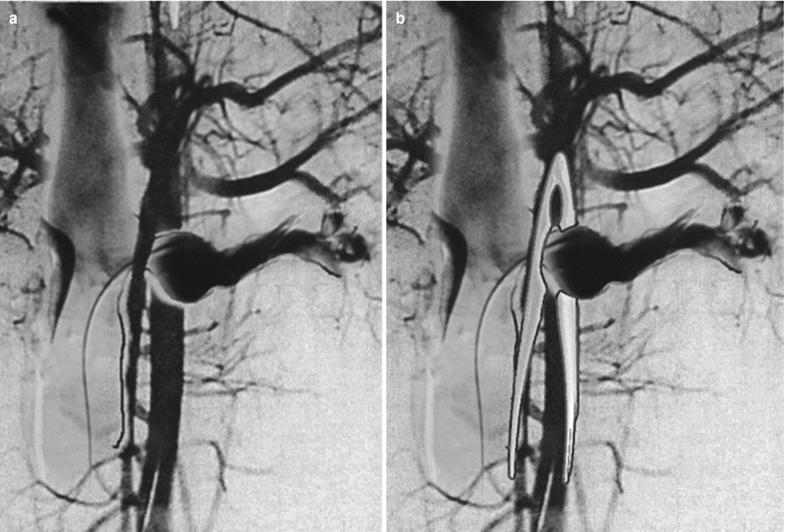 Nutcracker Syndrome SpringerLink