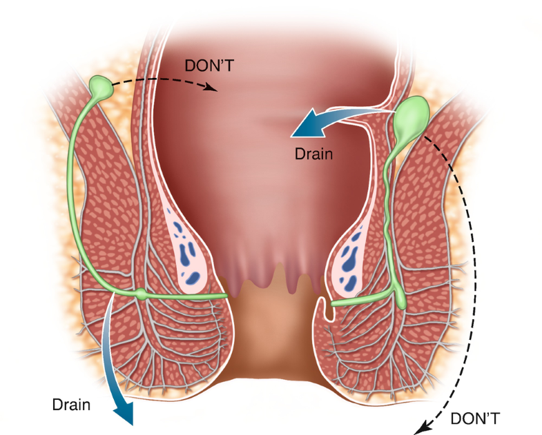 abcess s Anal crohn HQ Photo Porno Im playing with my clitoris