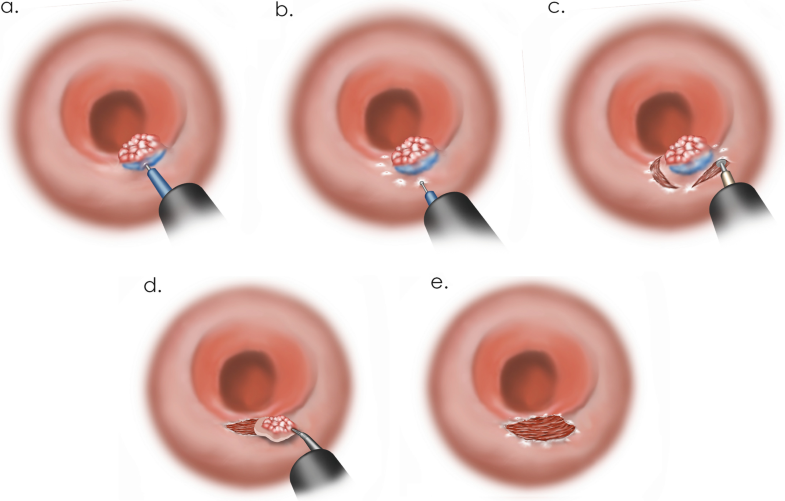 Endoscopic Management of Polyps, Polypectomy, and Combined Endoscopic