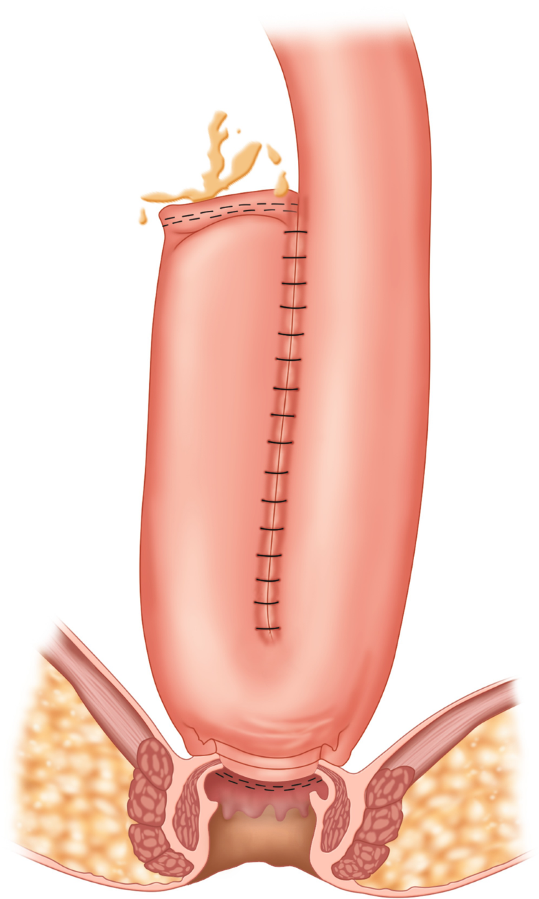 Complications of the Ileal Pouch SpringerLink