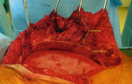 Posterior Component Separation Via Transversus Abdominis Muscle Release