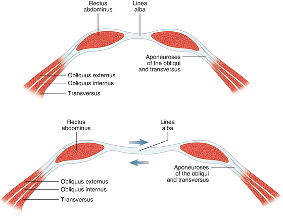 Diagnosis and Management of Diastasis Recti | SpringerLink