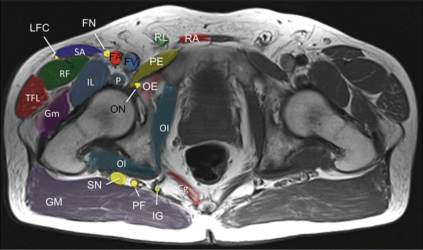 Inferior Gluteal Nerve Entrapment | SpringerLink