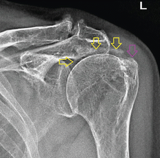 Radiology and Ultrasonography Findings in Chondrocalcinosis | SpringerLink