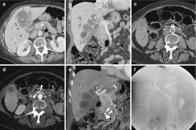 Black Stool After Ercp - Stools Item Black Stool After Ercp - Stools Item