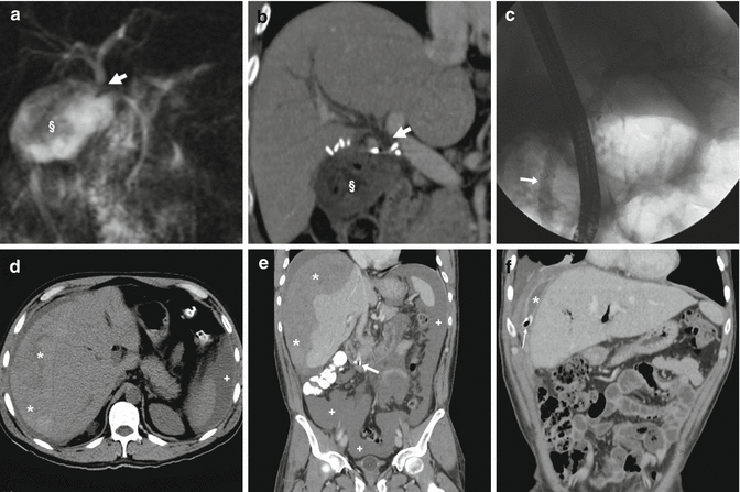 Black Stool After Ercp - Stools Item Black Stool After Ercp - Stools Item