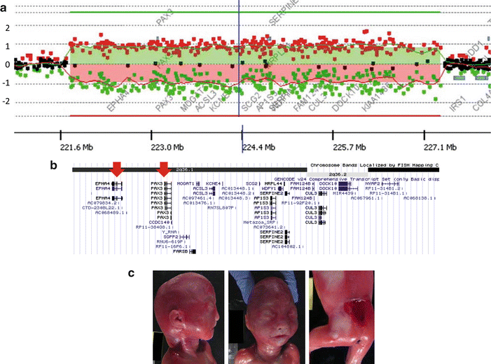 Basis of Neural Tube Defects SpringerLink