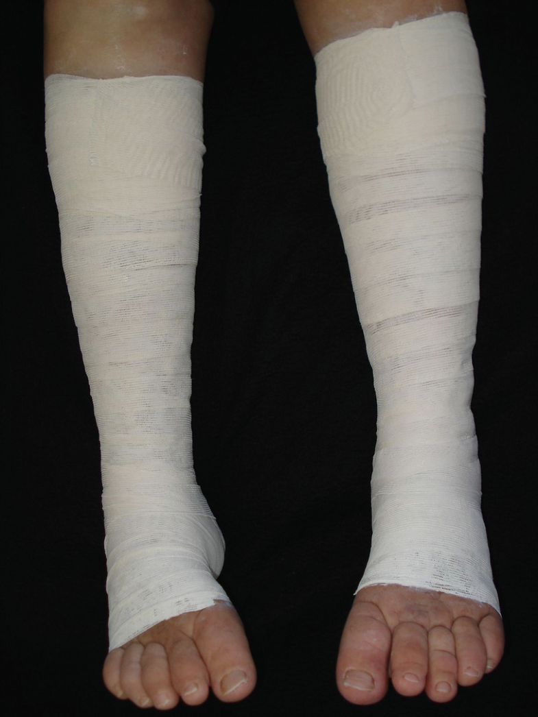 Leg Ulcers and Lymphedema SpringerLink