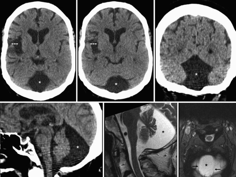 Петрифицированная менингиома. Киста в головном мозге на снимке мрт. Киста головного мозга на кт. Киста головного мозга после операции. Ретроцеребеллярная арахноидальная киста кт.