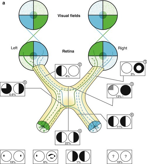Types of Homonymous Visual Field Defects | SpringerLink