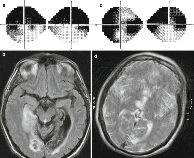 Types of Homonymous Visual Field Defects SpringerLink
