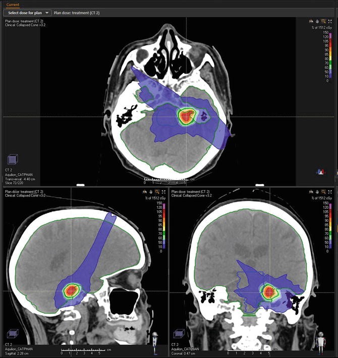 Radiation Therapy in Acoustic Neuroma SpringerLink