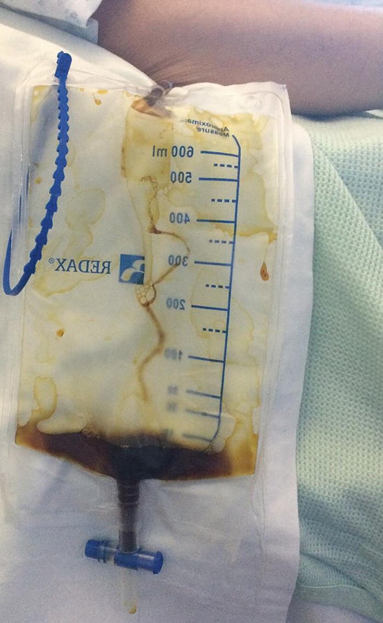 Identification and Management of Bile Leaks Post Cholecystectomy