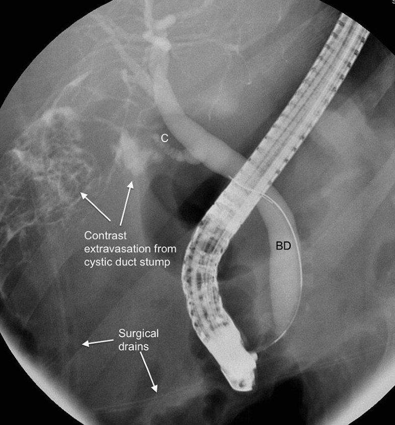 Identification and Management of Bile Leaks Post Cholecystectomy