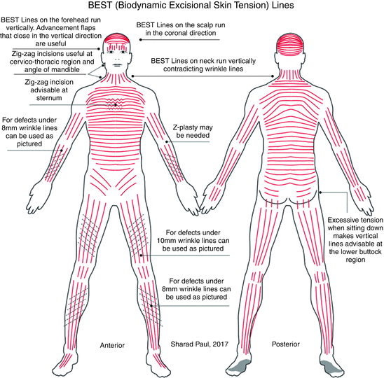 biodynamic-excisional-skin-tension-best-lines-on-the-trunk-springerlink