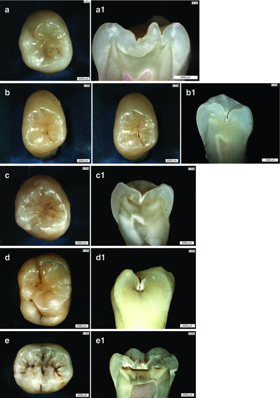 Detection of Occlusal Caries | SpringerLink