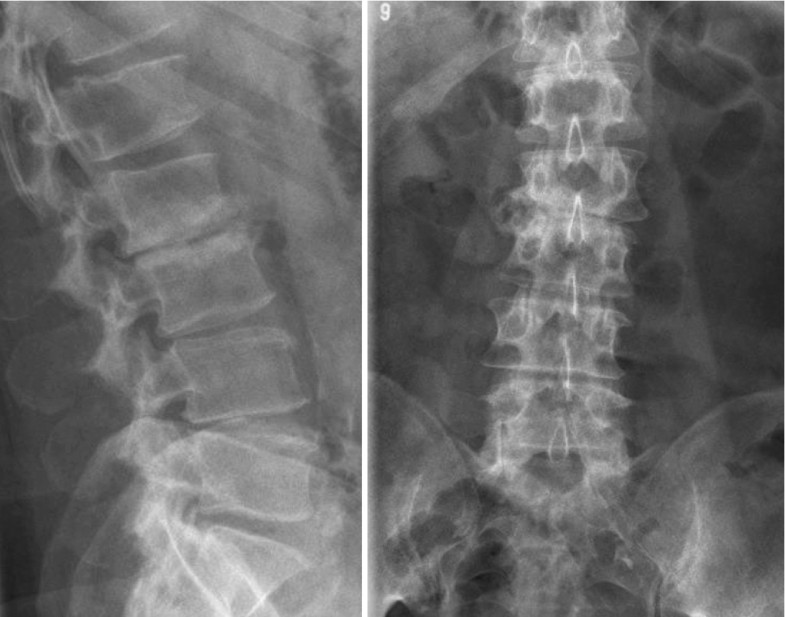 Vertebral Osteomyelitis: Etiology, Pathogenesis, Routes of Spread ...