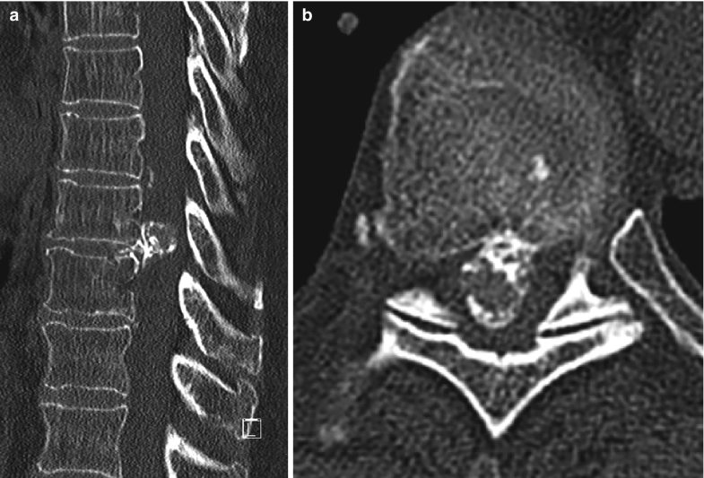 Thoracic Disc Herniation and Myelopathy SpringerLink