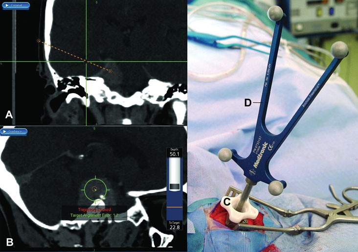 Miniframe Stereotactic Apparatus SpringerLink