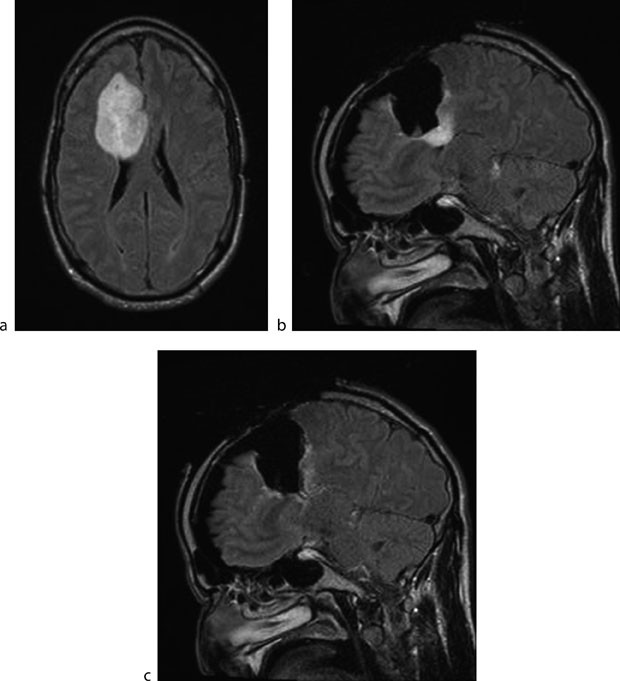 Image Guided Craniotomy for Brain Tumor SpringerLink