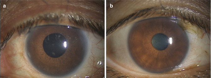Posner-Schlossman Syndrome | SpringerLink