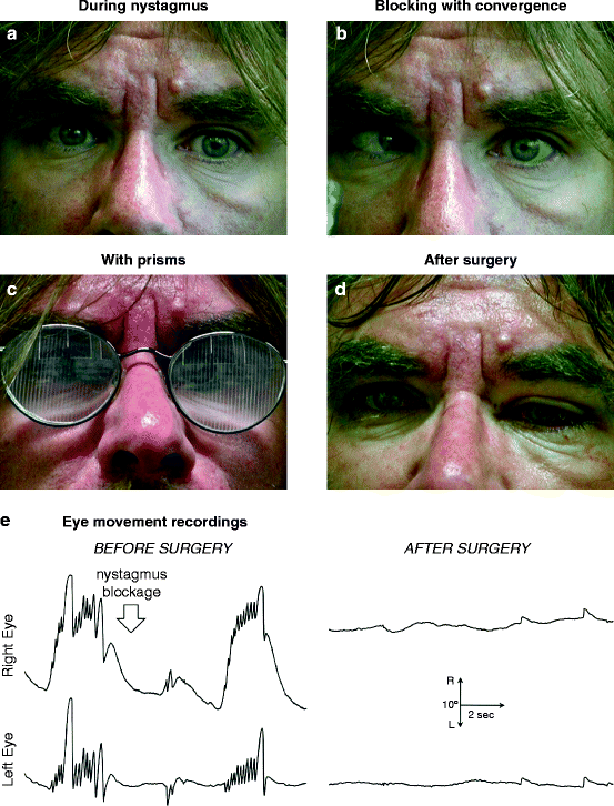 Management of Congenital Nystagmus with and without Strabismus