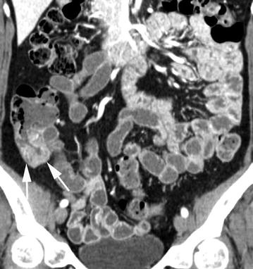 special screening for malignant neoplasmms of colol special screening for malignant neoplasmms of colol