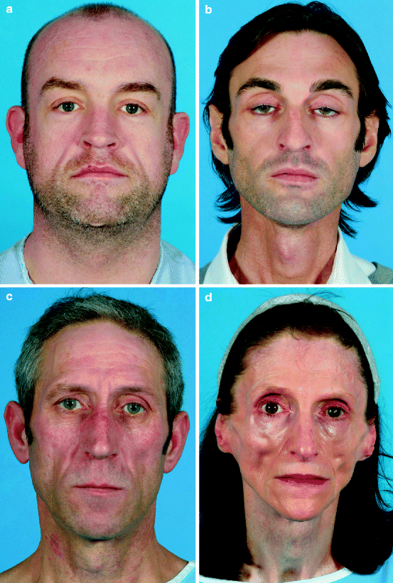 Autologous Fat Transfer for HIVAssociated Facial Lipodystrophy