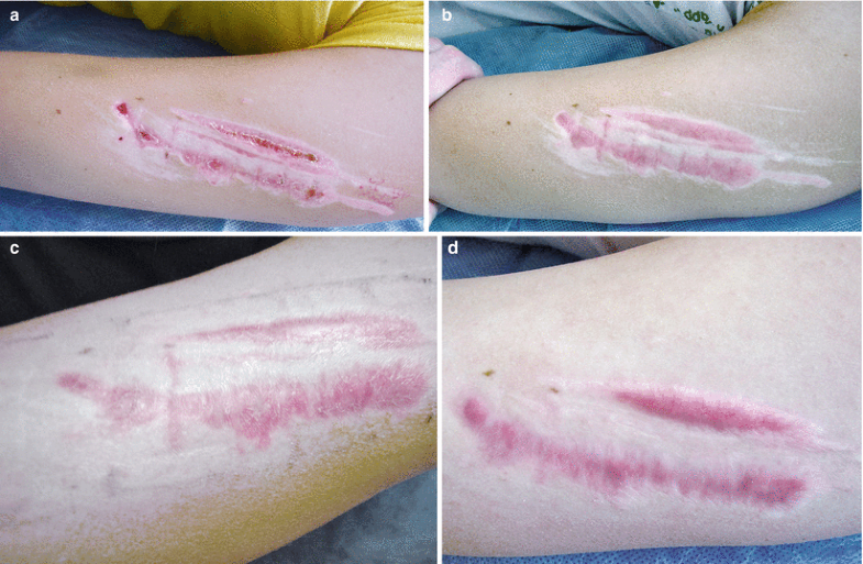 Pathological Scars (Keloid and Hypertrophic Scars) SpringerLink