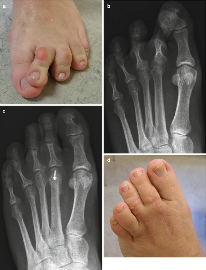 Lesser Toe Deformities SpringerLink