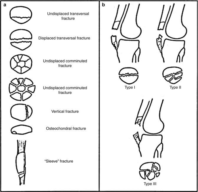 Fractures of the Patella Springer for Research & Development