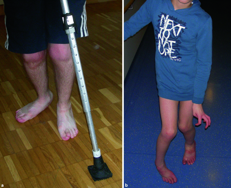 Infantile Zerebralparese SpringerLink