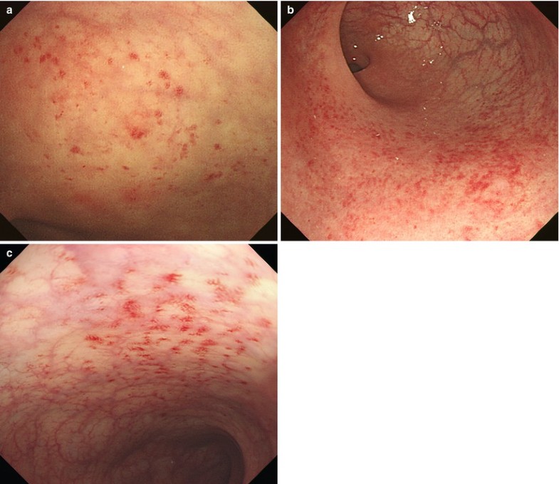 celiac disease colonoscopy findings celiac disease colonoscopy findings