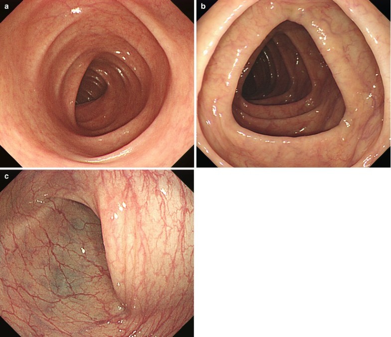 colonoscopy findings colonoscopy findings