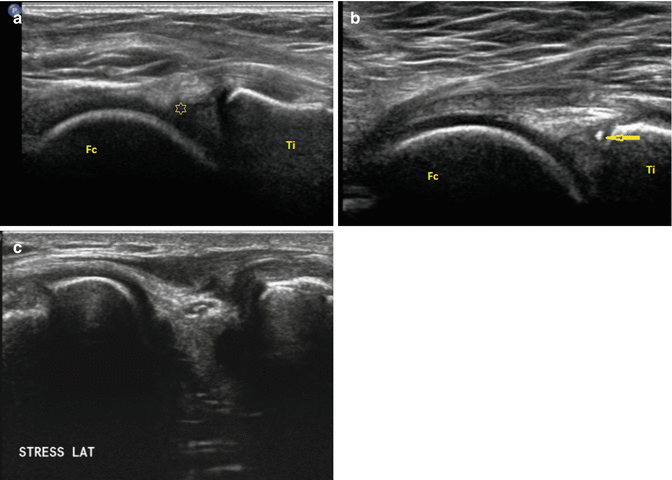 Meniscus Ultrasound | SpringerLink