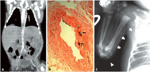 Infantile Arterienkalzifikation | SpringerLink