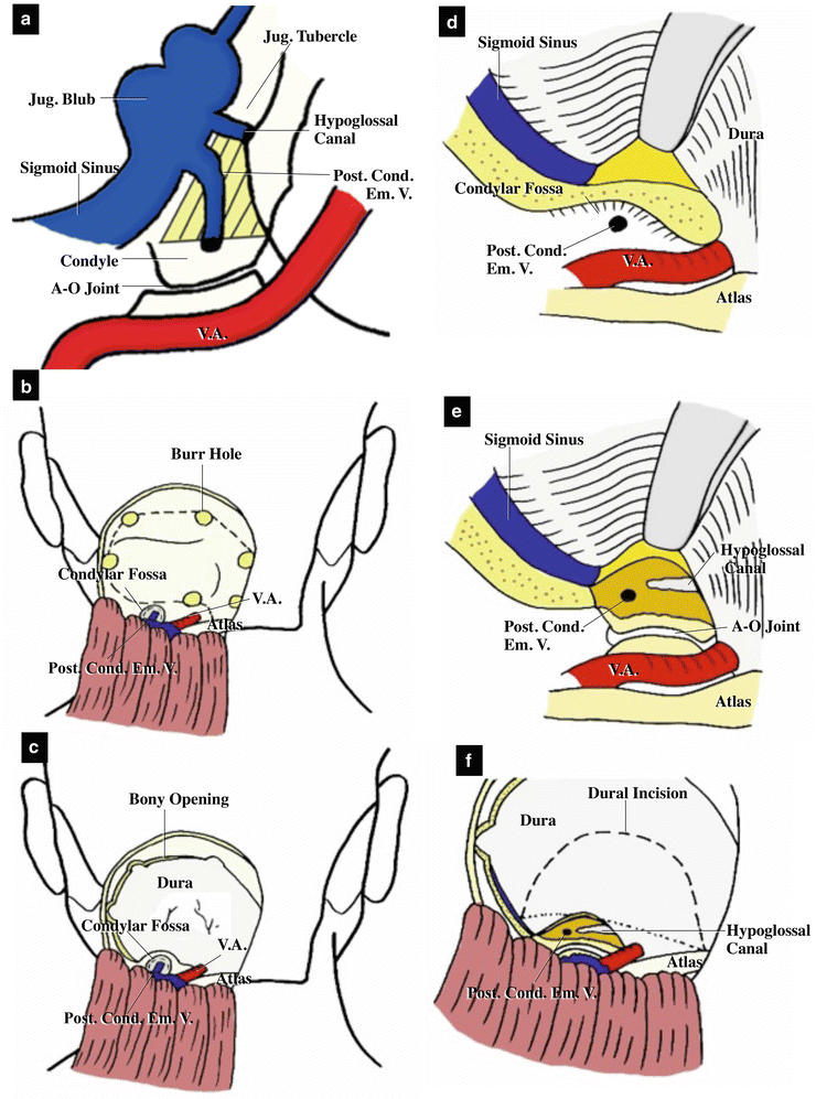 Surgical Anatomy Of And Approaches Through The Lateral Foramen Magnum The Transcondylar Fossa 8558