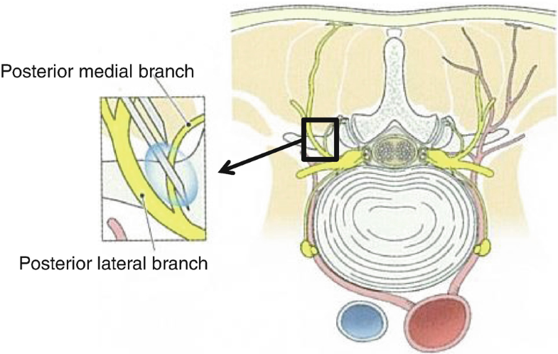 Radiofrequency Thermocoagulation of the Posterior Medial Branch of the ...