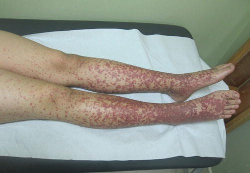 Vasculitis Henoch Schonlein Purpura Springerlink