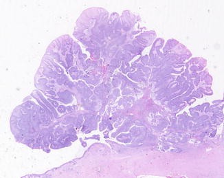 exophytic papilloma nasal)