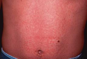 tipuri de viermi la adulți și tratament papilloma virus tumore ano