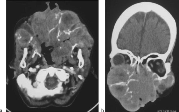 Neoplasms, Nose and Paranasal Sinus | SpringerLink