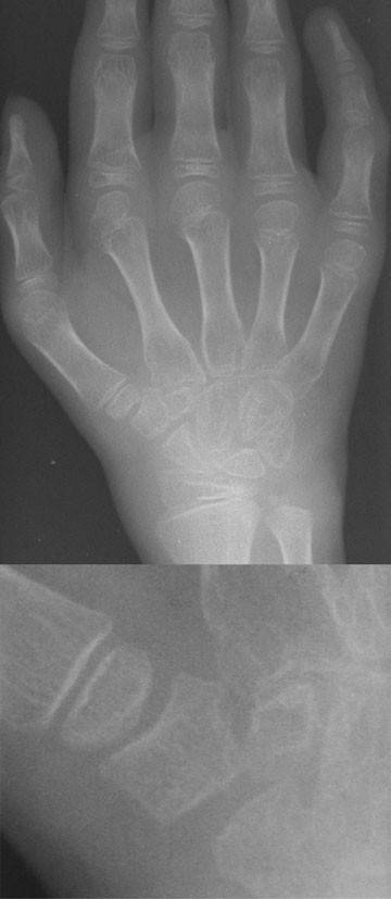 Bone Age Springerlink